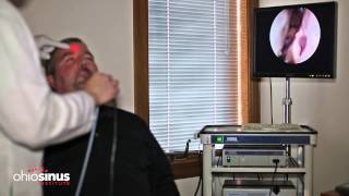 Nasal Endoscopy Informational Video by Ohio Sinus Institute [upl. by Sybille162]