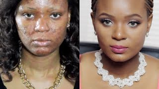 My Skin Care Miracle How I Got Rid of Acne Acneorg quotThe Regimenquot [upl. by Colombi469]