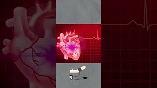 Why heart attack mostly occur on Monday [upl. by Anaihr]