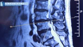 Discectomy vs Laminotomy by Dr Tony Mork [upl. by Treblah500]