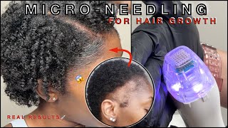 MICRONEEDLING  PRP FOR EDGE GROWTH 💉 FULL PROFESSIONAL JOURNEY  TRACTION ALOPECIA 🚨  FAQ [upl. by Yentihw933]