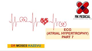 ECG Atrial enlargement Part 7 [upl. by Finstad]