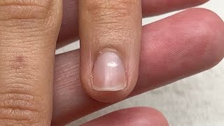 What is happening with this nail Punctate Leukonychia [upl. by Aynatan]