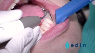 Ultrasoon reinigen bij parodontitis  Edin Dental Academy [upl. by Laurentia845]