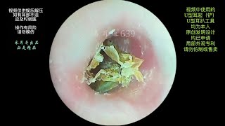 采耳哥Fine operation to clean the hard earwax on the eardrum  639 [upl. by Anicart]