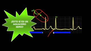 CURSO DE ELECTROCARDIOGRAFIA 47  EXTRASÍSTOLES SUPRAVENTRICULARES [upl. by Salkin647]