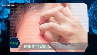 ¿Qué es y cómo tratar una dermatitis atópica [upl. by Anaeirb]