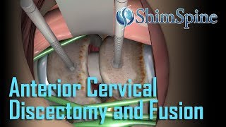 Anterior Cervical Discectomy and Fusion [upl. by Mozelle167]