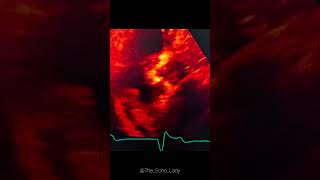 Endocarditis vs Thrombus🩸🦠 endocarditis echocardiography cardiologie cardiology [upl. by Maletta]