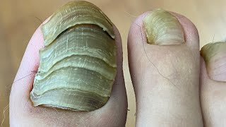 Así tratamos un dedo con HONGOS de hasta 5 UÑAS nails foot viral pedicure [upl. by Hartzke]