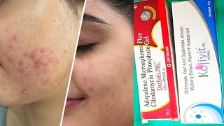 Deriva cms gel uses and kojivit gel uses in hindi best for pimple and pimple dark spot पिंपल के दाग [upl. by Aratihc918]