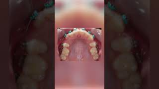 Braces Changes Timelapse of the Upper teeth with Extractions  TheBracesDoc [upl. by Leuqcar853]