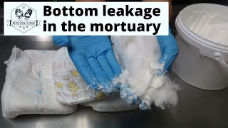 Stopping the leakage from bottoms in the mortuary [upl. by Ellennej]