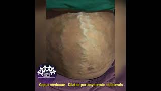 CAPUT MEDUSAE  Dilated Portosystemic collaterals [upl. by Onaivlis]