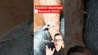 Stunning HUGE BLACKHEAD REMOVAL  Biggest Blackhead 2024 shorts [upl. by Segalman]