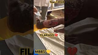 🧑🏻‍🔬FILARIASIS 💔mbbsdoctorfilariasisjoharimbbsneetmbbmbbsdairiesdiseasecancerlifestylepw🪷 [upl. by Wichman]