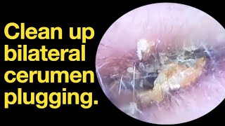 Clean up bilateral cerumen plugging ear wax removal  ear cleaning  ASMR  relaxation  relax [upl. by Ahsiym714]