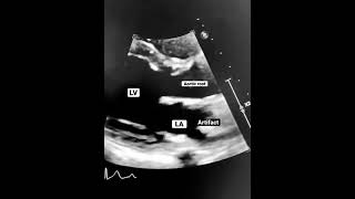 SteroidResponsive Severe Pneumonia PostCOVID19 in a Patient with PANDAS A Case Study [upl. by Elehcim155]