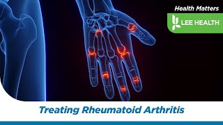 Treating Rheumatoid Arthritis [upl. by Rezeile]