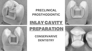 Dental Inlay Cavity Preparation  Taper  Bevel [upl. by Duarte]