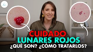 🔴 ATENCION Si tienes LUNARES ROJOS haz ESTO drapilarochoa  Dermatologa [upl. by Yrakcaz652]