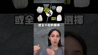 後牙的假牙材質怎麼選全鋯冠全瓷冠PFM瓷牙 [upl. by Sopher27]