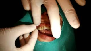 How to use the superfloss between dental bridge [upl. by Akiras]