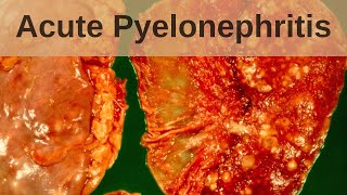 Acute pyelonephritis  Pathology mini tutorial [upl. by Ahsinrat]