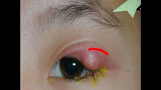 STYE  Disease of an Eyelid [upl. by Oremoh]