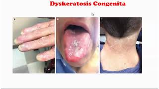 Dyskeratosis Congenita [upl. by Gareri]