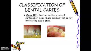 Lecture Day 2 Review of Cariology [upl. by Aynwad]