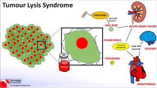 Tumour Lysis Syndrome [upl. by Dnar]