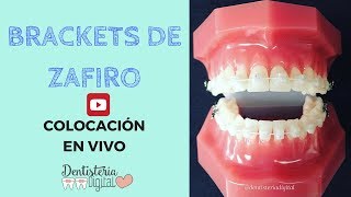 Colocación de brackets de Zafiro EN VIVO [upl. by Ohare573]