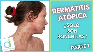 DERMATITIS ATÓPICA 😳 ¿Solo son ronchitas 🤔 [upl. by Auston564]