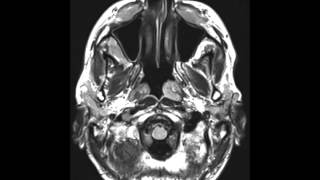 Chronic Lymphocytic Leukemia of the Maxillofacial Region [upl. by Goldie]