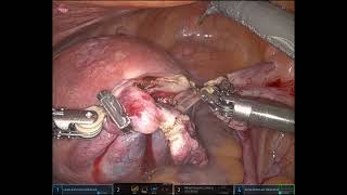 Straight forward Robotic TLH lysis of bladder adhesions [upl. by Narton]