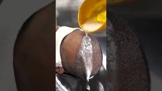 Expert Tips for First Shampoo After Hair Transplant  Cara Clinic [upl. by Nalliuq]