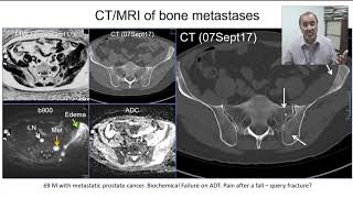 Bone metastases – One Disease with Many Signs [upl. by Ardussi243]