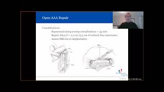 2021 CTACSPA ABSITE Review Vascular [upl. by Kramlich]