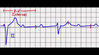 Cardiac Pacing Failure to CaptureFailure to Sense [upl. by Nonnaer613]