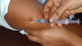 IM Intramuscular Arm injection Push Ketorolac  Xerokit  injection Ep 34 Injection Vision [upl. by Alexandria]