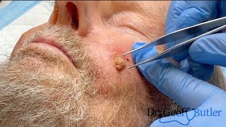 Removal of a Basal Cell Cancer on the face [upl. by Maxine]