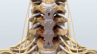 650K Result Animated C47 Anterior Cervical Discectomy with Fusion [upl. by Seuqram]