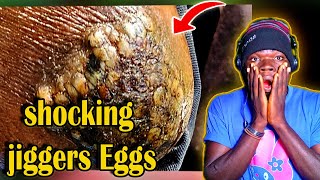 Jiggers shocking jiggers Eggs [upl. by Sabsay]