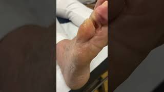 Experience pain relief Watch an Aussie podiatrist remove corns amp calluses [upl. by Arndt]