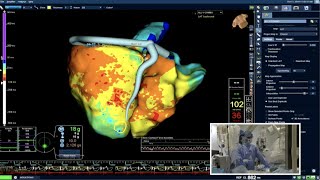 Live Case PVC Ablation  Marchlinski Electrophysiology Lab at Penn Medicine [upl. by Layod]