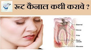 Root Canal Treatment Marathi  रूट कैनाल ट्रीटमेंट [upl. by Ferne]