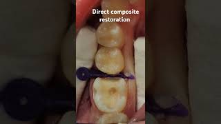 حشوة تجميلية shofu direct composite restoration dentist دكتورالاسنان [upl. by Tacy]