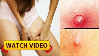 She Use These Effective Remedies to Get Rid Of Boils on Inner Thighs and Buttocks [upl. by Selin]