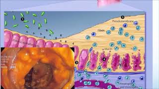 عدوى الكلوستريديوم العسير  Clostridioides difficile infection [upl. by Janna]